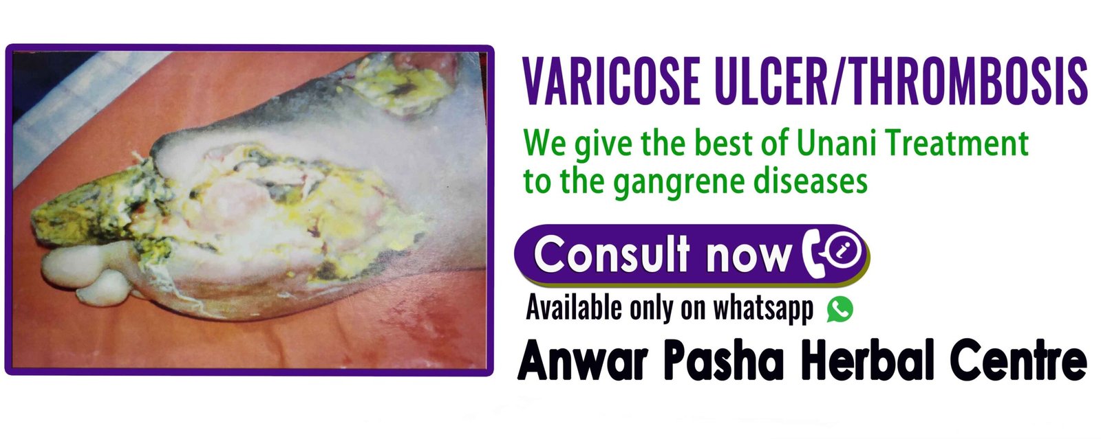 varicouse